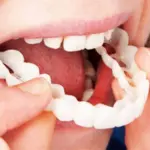 Adjustable Snap-On Dentures