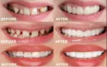Adjustable Snap-On Dentures - Image 11