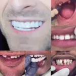 Adjustable Snap-On Dentures - Image 14